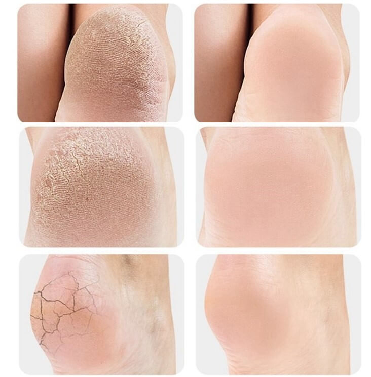 Calcanheira Ortopédica para Fascite Plantar
